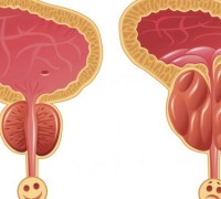 СРАВНИТЕЛЬНЫЙ АНАЛИЗ ЭФФЕКТИВНОСТИ КОМБИНИРОВАННОГО ФИТОПРЕПАРАТА ПРОСТОТИАЛЬ И МОНОТЕРАПИИ ПРОСТАМОЛ УНО В ЛЕЧЕНИИ ДОБРОКАЧЕСТВЕННОЙ ГИПЕРПЛАЗИИ ПРЕДСТАТЕЛЬНОЙ ЖЕЛЕЗЫ