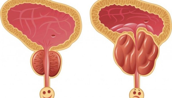 СРАВНИТЕЛЬНЫЙ АНАЛИЗ ЭФФЕКТИВНОСТИ КОМБИНИРОВАННОГО ФИТОПРЕПАРАТА ПРОСТОТИАЛЬ И МОНОТЕРАПИИ ПРОСТАМОЛ УНО В ЛЕЧЕНИИ ДОБРОКАЧЕСТВЕННОЙ ГИПЕРПЛАЗИИ ПРЕДСТАТЕЛЬНОЙ ЖЕЛЕЗЫ