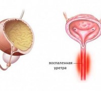 Цистит и уретрит: двойной удар по комфорту. Как вернуть здоровье мочеполовой системе?