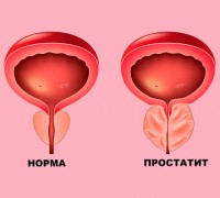 Простатит: как предотвратить, а не лечить. Комплексный подход к мужскому здоровью
