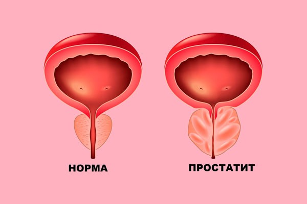 Простатит: как предотвратить, а не лечить. Комплексный подход к мужскому здоровью
