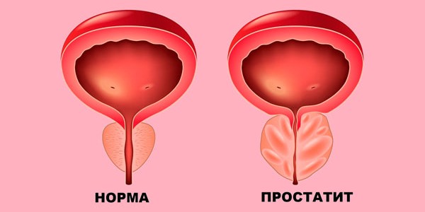 Простатит: как предотвратить, а не лечить. Комплексный подход к мужскому здоровью