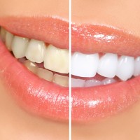 Отбеливание зубов: за и против