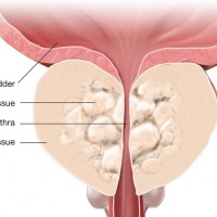 Научный обзор: потенцирование терапии доброкачественной гиперплазии предстательной железы при комбинации фитонирингового препарата Простотиаль с α1-адреноблокаторами 