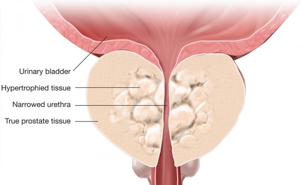 Научный обзор: потенцирование терапии доброкачественной гиперплазии предстательной железы при комбинации фитонирингового препарата Простотиаль с α1-адреноблокаторами 