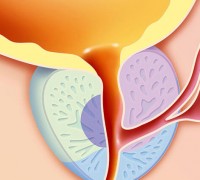 РОЛЬ КОМБИНИРОВАННОГО ФИТОПРЕПАРАТА ПРОСТОТИАЛЬ ФОРТЕ В КОМПЛЕКСНОЙ ТЕРАПИИ ХРОНИЧЕСКОГО БАКТЕРИАЛЬНОГО ПРОСТАТИТА: ВЛИЯНИЕ НА ЧАСТОТУ РЕЦИДИВОВ
