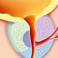 РОЛЬ КОМБИНИРОВАННОГО ФИТОПРЕПАРАТА ПРОСТОТИАЛЬ ФОРТЕ В КОМПЛЕКСНОЙ ТЕРАПИИ ХРОНИЧЕСКОГО БАКТЕРИАЛЬНОГО ПРОСТАТИТА: ВЛИЯНИЕ НА ЧАСТОТУ РЕЦИДИВОВ