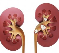 Мочекаменная болезнь: природа подсказывает путь к очищению и защите